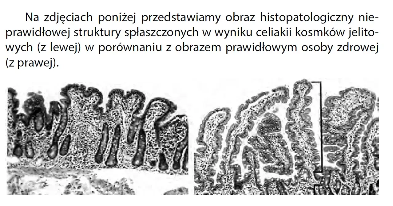 Celiakia - charakterystyczne objawy choroby trzewnej
