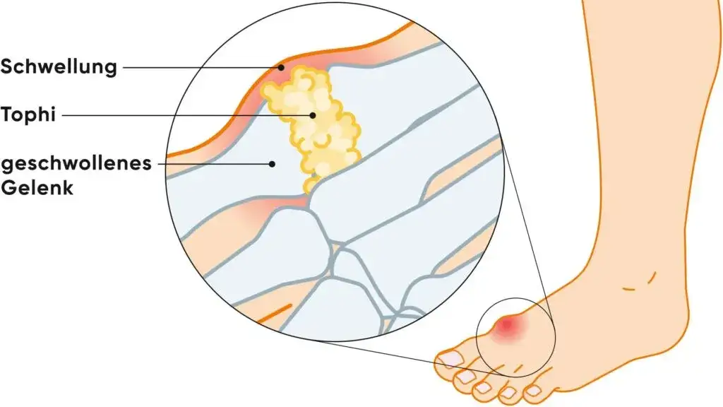 Gicht Symptome Fuß: So erkennen Sie die schmerzhaften Anzeichen
