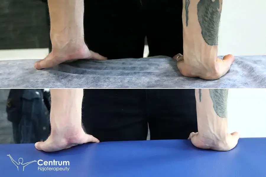 Rehabilitacja po złamaniu nadgarstka: Ile trwa i co przyspieszy?