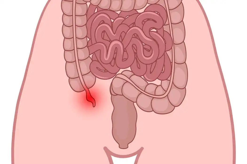 Objawy zapalenia wyrostka robaczkowego u dziecka – nie ignoruj tych sygnałów