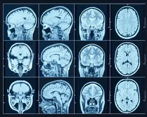 Czy rezonans wykryje choroby psychiczne? Prawda o MRI głowy