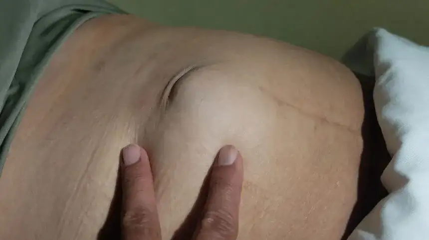 Gorączka po operacji przepukliny: przyczyny i kiedy do lekarza