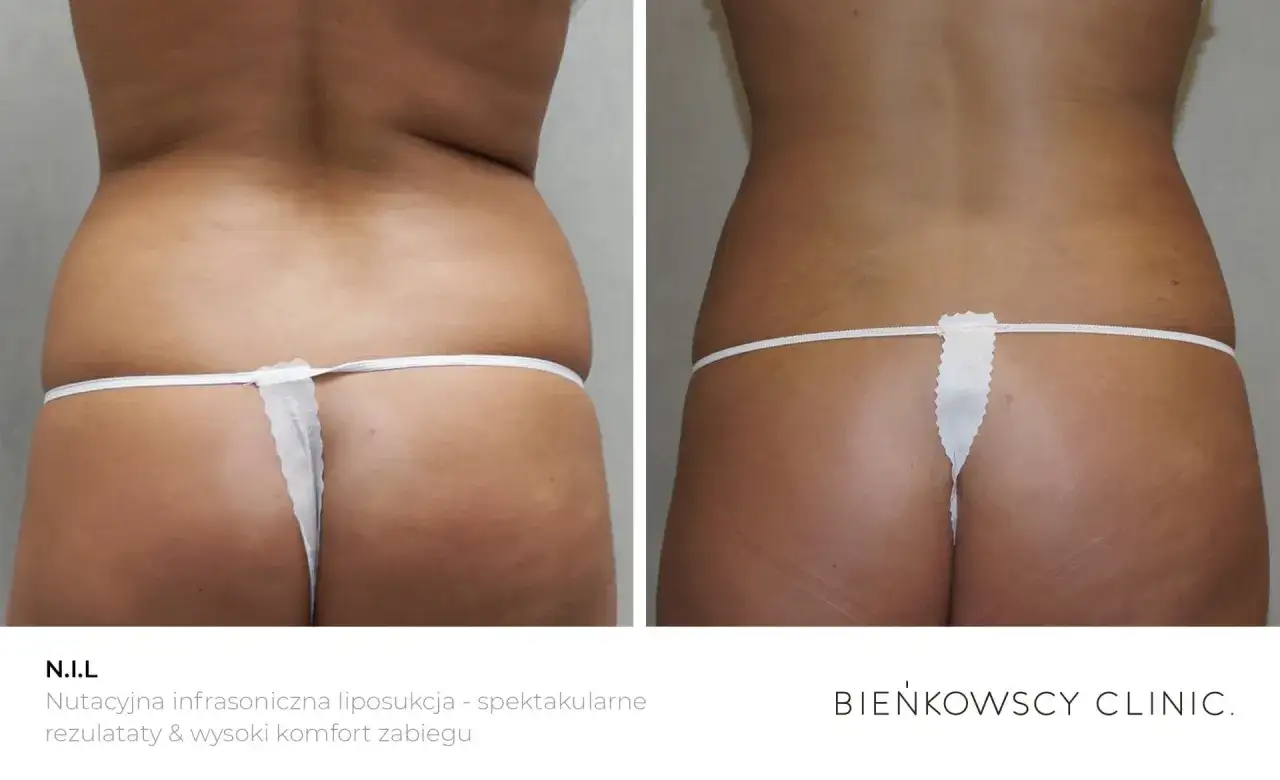 Liposukcja bezpieczna? Poznaj ryzyko i podejmij świadomą decyzję