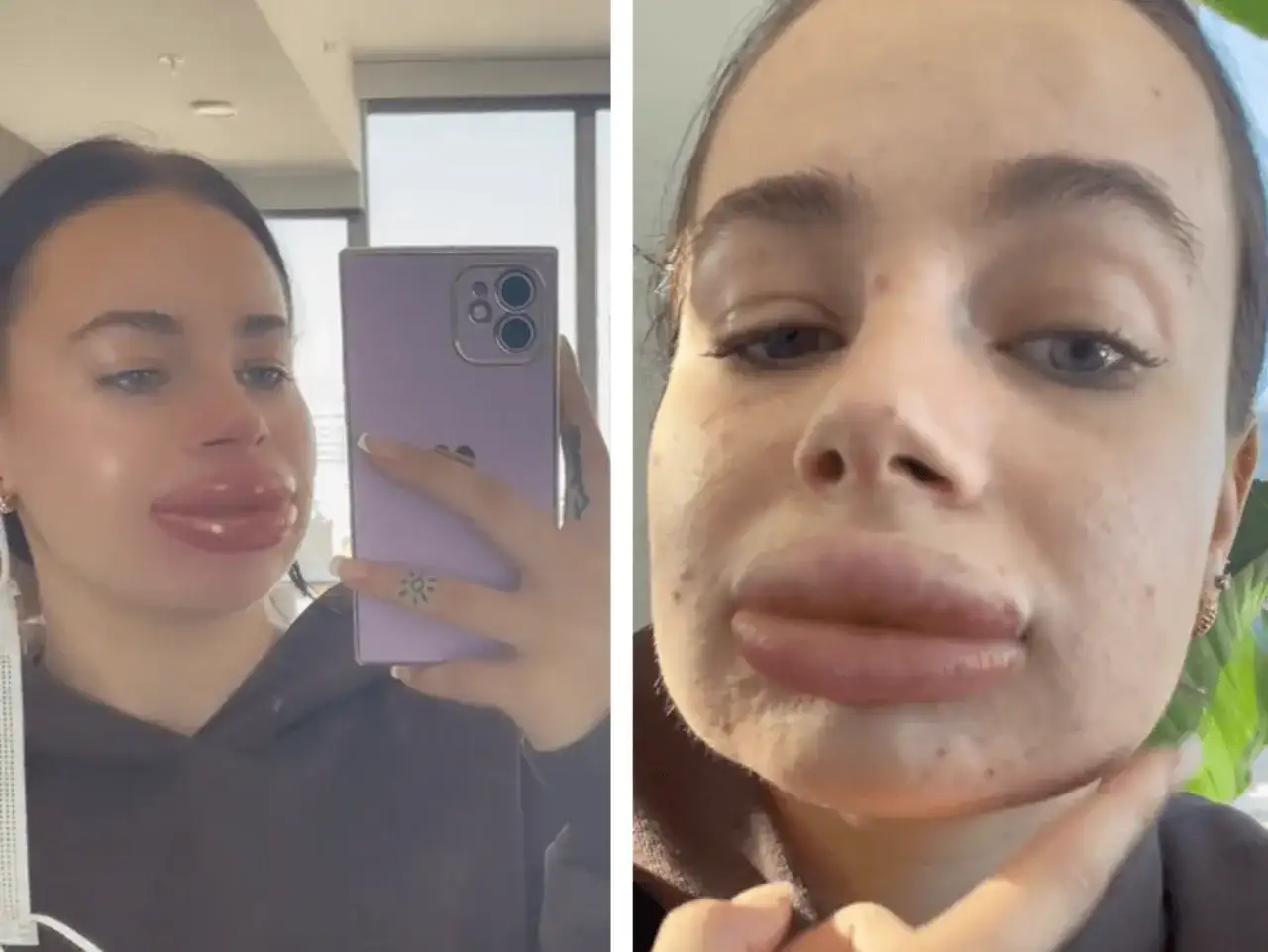 Jak zmniejszyć obrzęk po powiększaniu ust? Skuteczne porady eksperta