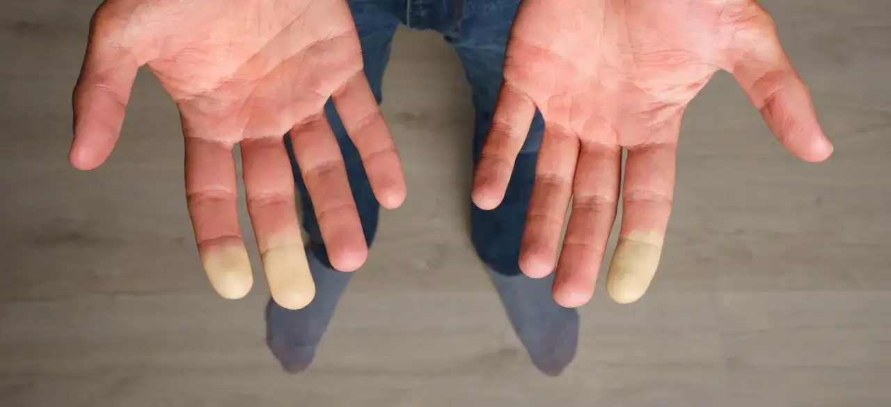 Dłonie z bladymi palcami, objaw Raynauda, może być powiązany z problemami z tarczycą.