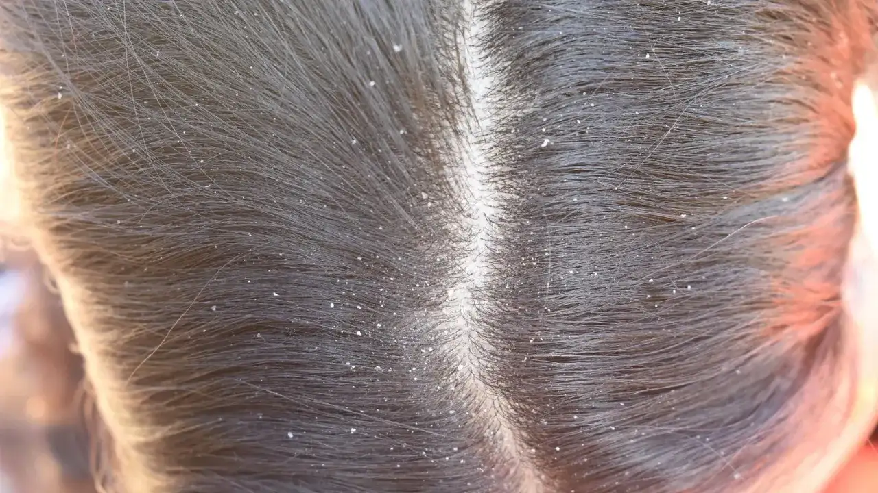 Widok z bliska na ciemne włosy z widocznym łupieżem. Dowiedz się, jak zwalczyć łupież domowymi sposobami.