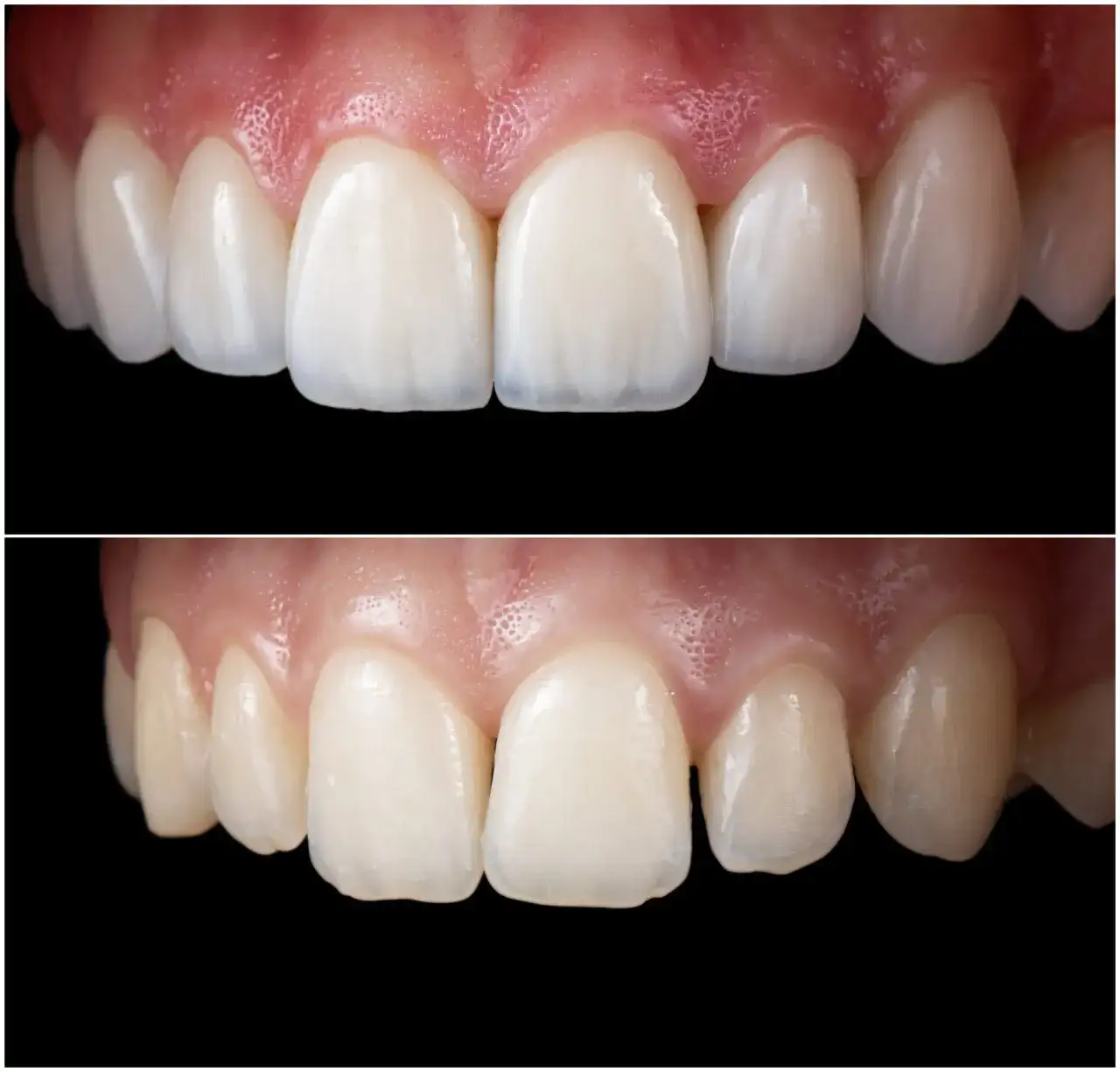 Bonding zębów: Jak działa, ile kosztuje i czy to dla Ciebie?