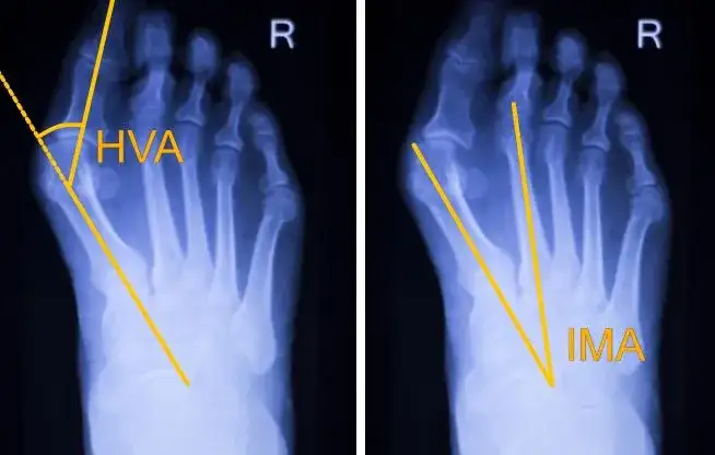 Haluks: Operacja krok po kroku. Co musisz wiedzieć przed zabiegiem?