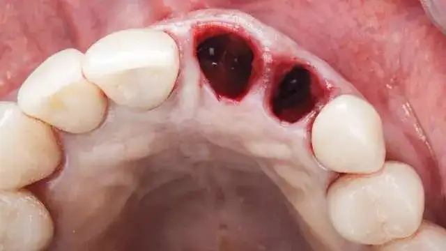 Czym smarować dziąsło po wyrwaniu zęba, aby uniknąć bólu?