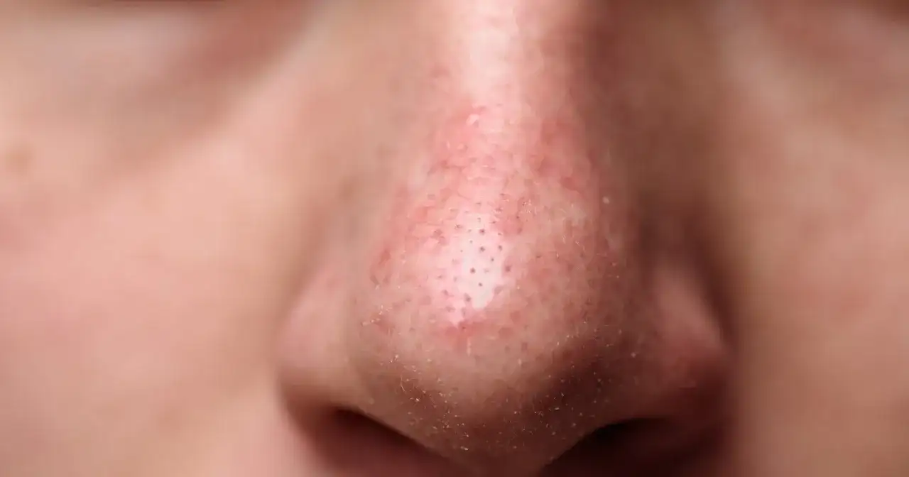 Pryszcze na nosie: Dlaczego powstają i jak się ich skutecznie pozbyć?