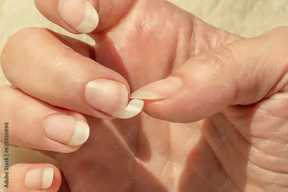 Złamany paznokieć? Szybki ratunek: domowe sposoby i porady eksperta