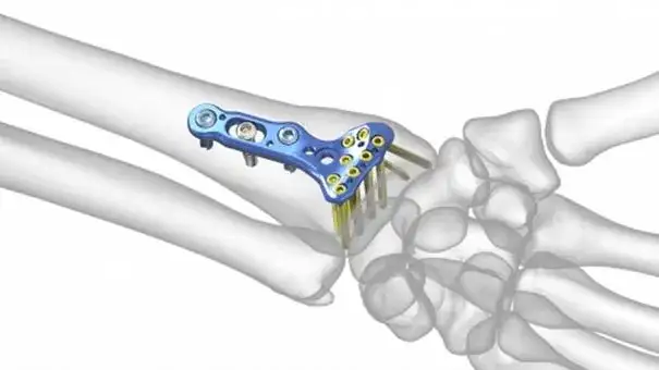 Ile trwa rehabilitacja po złamaniu nadgarstka? Kluczowe informacje o czasie powrotu do zdrowia
