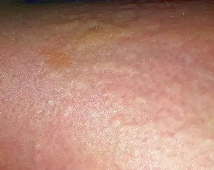 Gluten intoleranz symptome: Erkennen Sie die versteckten Anzeichen