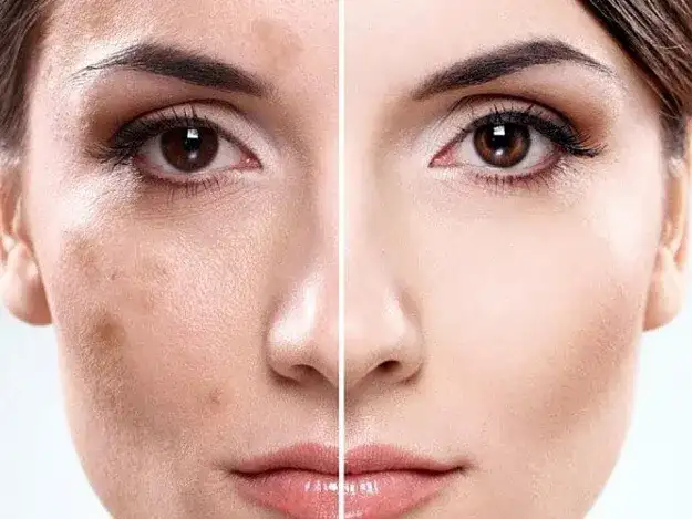 Słońce po depilacji laserowej? Poznaj zasady i uniknij przebarwień