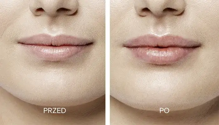 Ile kosztuje 1 ml kwasu hialuronowego w usta? Sprawdź ceny w klinikach