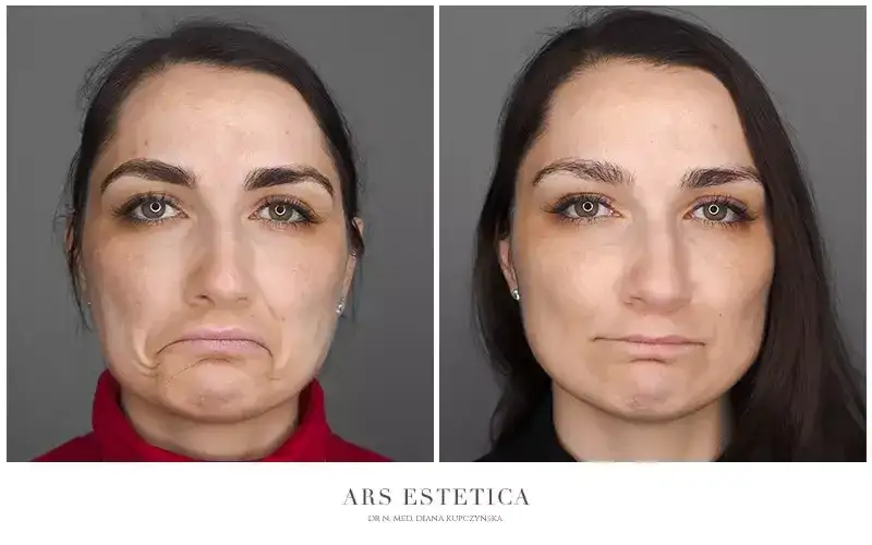 Botoks na czoło: Ile jednostek dla naturalnego efektu? Koszt