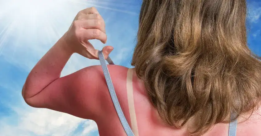 Skuteczne leki na oparzenia słoneczne, które przyniosą ulgę i szybkie wyleczenie
