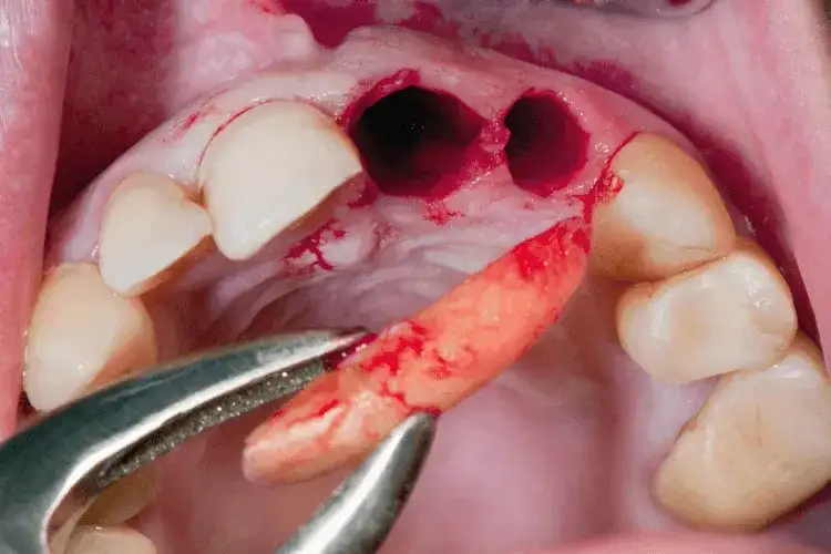 Palenie po dentyście: Suchy zębodół, implanty. Jak długo czekać?