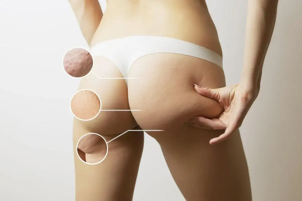 Zbliżenie na pośladki z zaznaczonymi niedoskonałościami skóry. Czy to możliwe, jak pozbyć się cellulitu w tydzień?