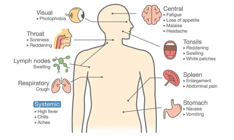 Síntoma de la mononucleosis: identifica los signos y evita complicaciones