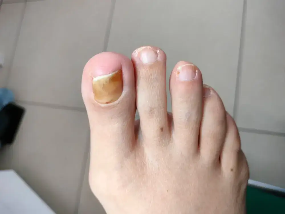 Skuteczne sposoby na pękające paznokcie u nóg - domowe kuracje