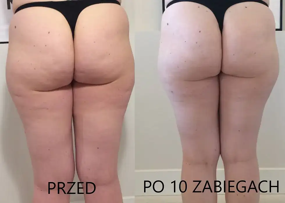 Masaż bańką chińską na cellulit: Instrukcja krok po kroku i efekty