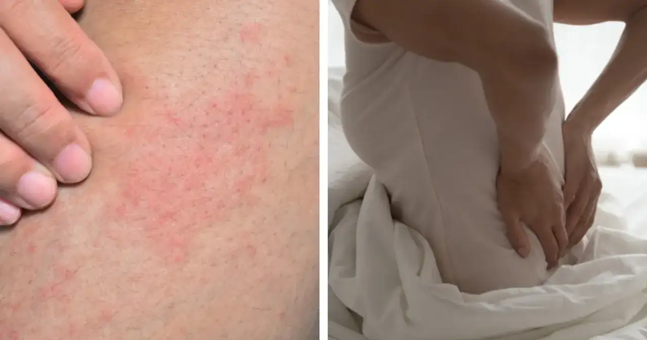 Dwa obrazy: wysypka na skórze i osoba trzymająca się za plecy.