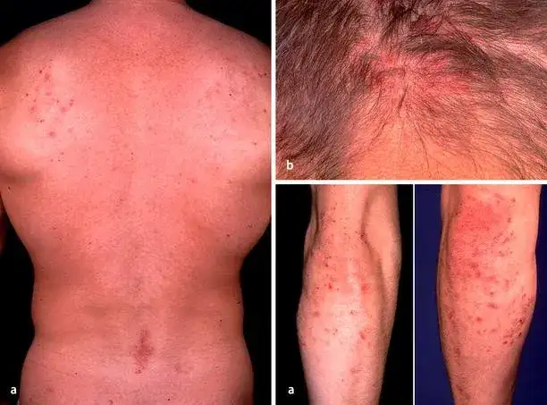 Morbus Duhring Diagnostik: Wichtige Tests und Verfahren zur sicheren Diagnose