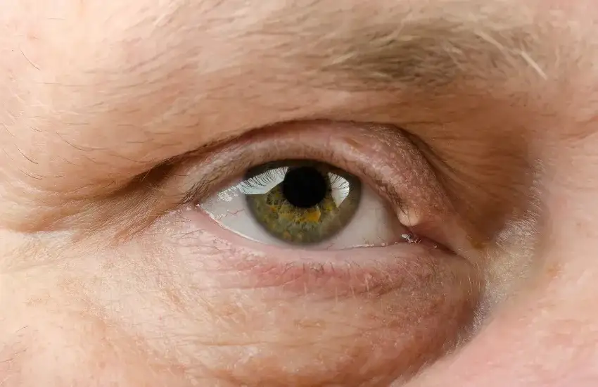 Czerwona plamka na oku – co oznacza i jak uniknąć poważnych problemów