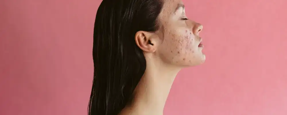 Jak pozbyć się blizn po pryszczach - skuteczne metody i porady