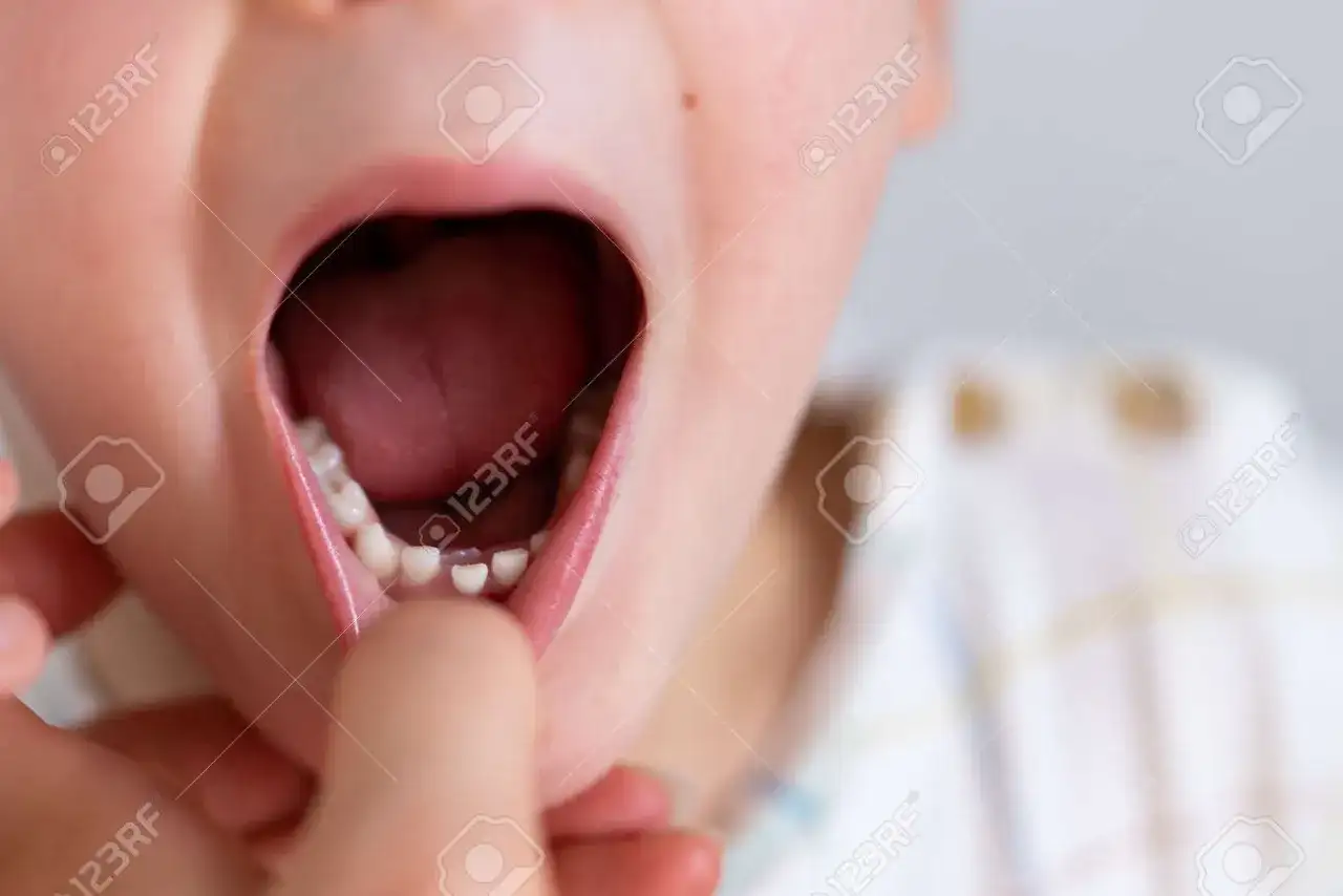 Zęby rekina u dziecka: kiedy działać, a kiedy obserwować?