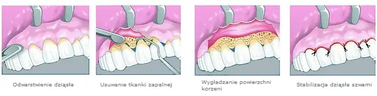 Ile trwa zdjęcie szwów z dziąsła? Szybki i bezbolesny proces