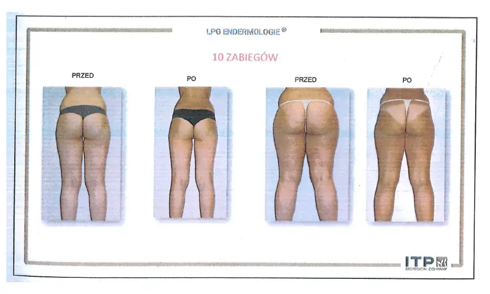 Endermologia: Ile zabiegów dla gładkiej skóry? Plan kuracji