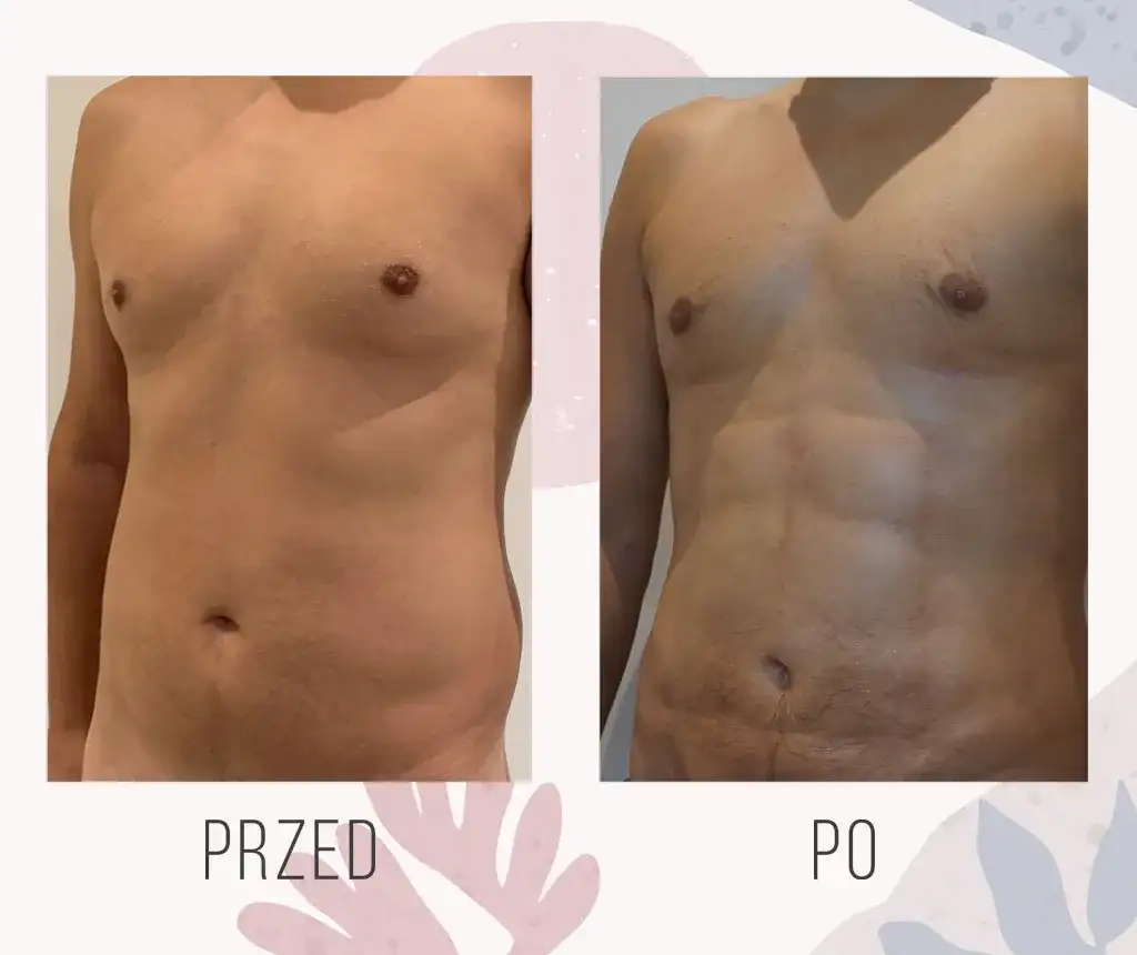 Ile kosztuje zabieg liposukcji? Sprawdź ceny i ukryte koszty