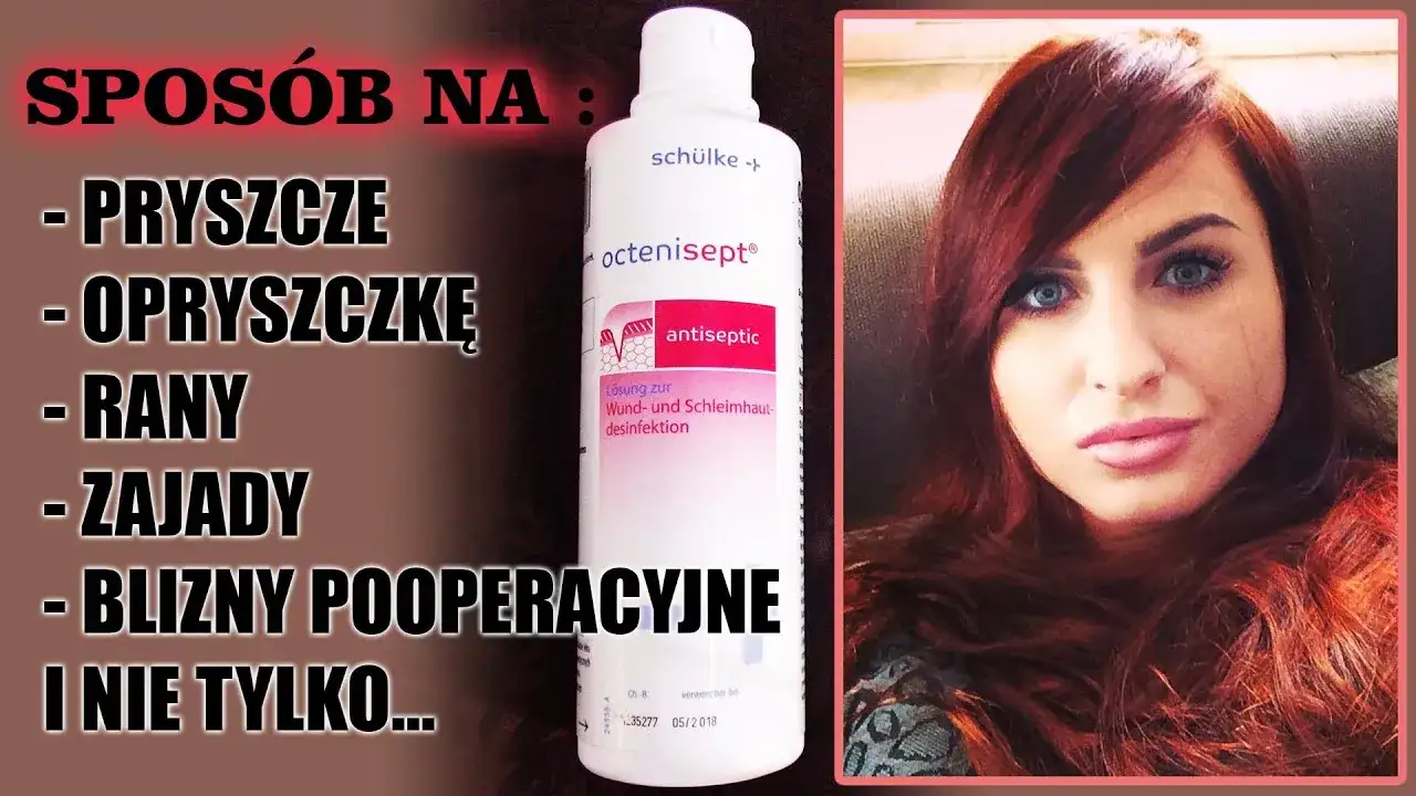 Co na wycisniete pryszcze: skuteczne metody na podrażnienia i blizny