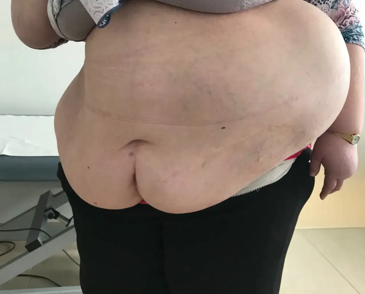 Przepuklina brzuszna u dorosłych - 7 niepokojących objawów