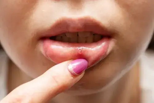 Opryszczkowe zapalenie jamy ustnej u dzieci - ile trwa i jak złagodzić objawy