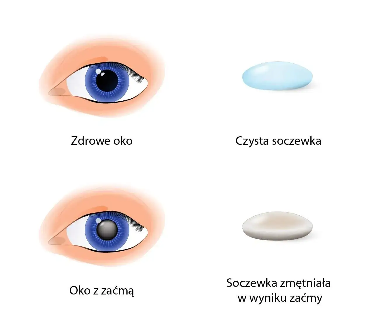 Ile się czeka na operację zaćmy? Poznaj zaskakujące fakty i terminy