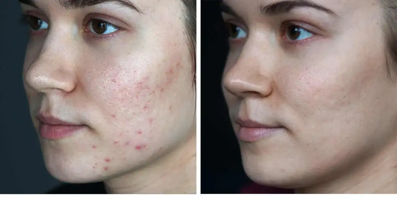 Skuteczne metody na blizny po pryszczach – jak je zredukować?