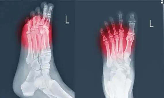 Skręcenie śródstopia objawy - jak rozpoznać ból i obrzęk stopy