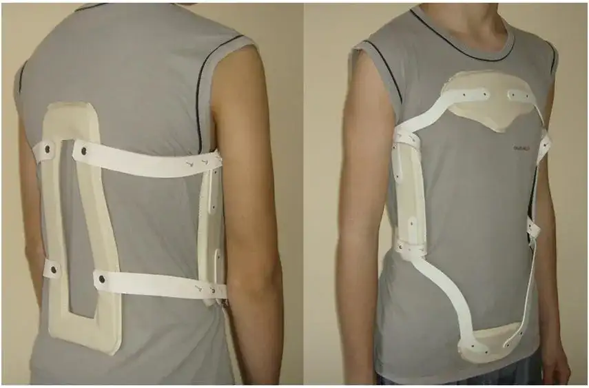 Gorset ortopedyczny przy złamaniu kręgosłupa - kluczowe informacje