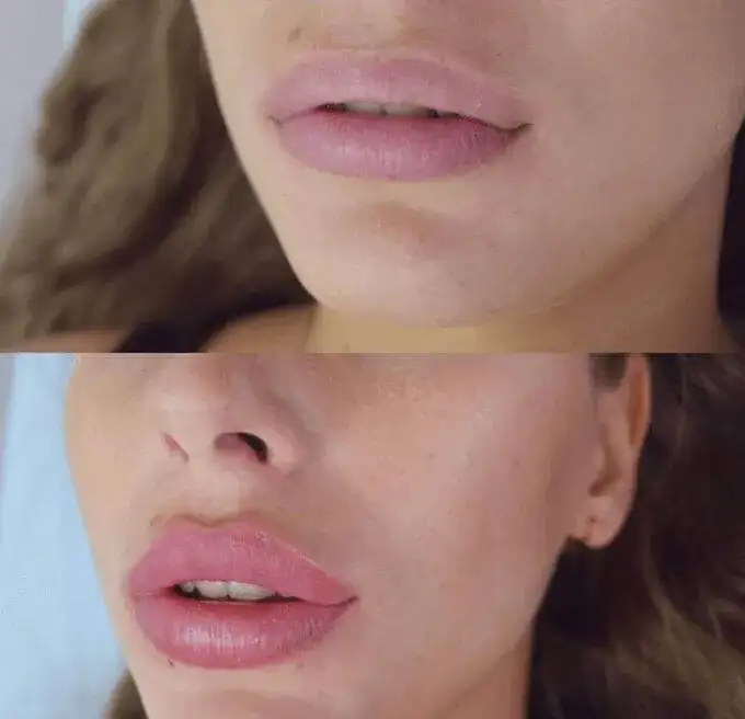 Jak uśmierzyć ból po powiększaniu ust - skuteczne metody i porady