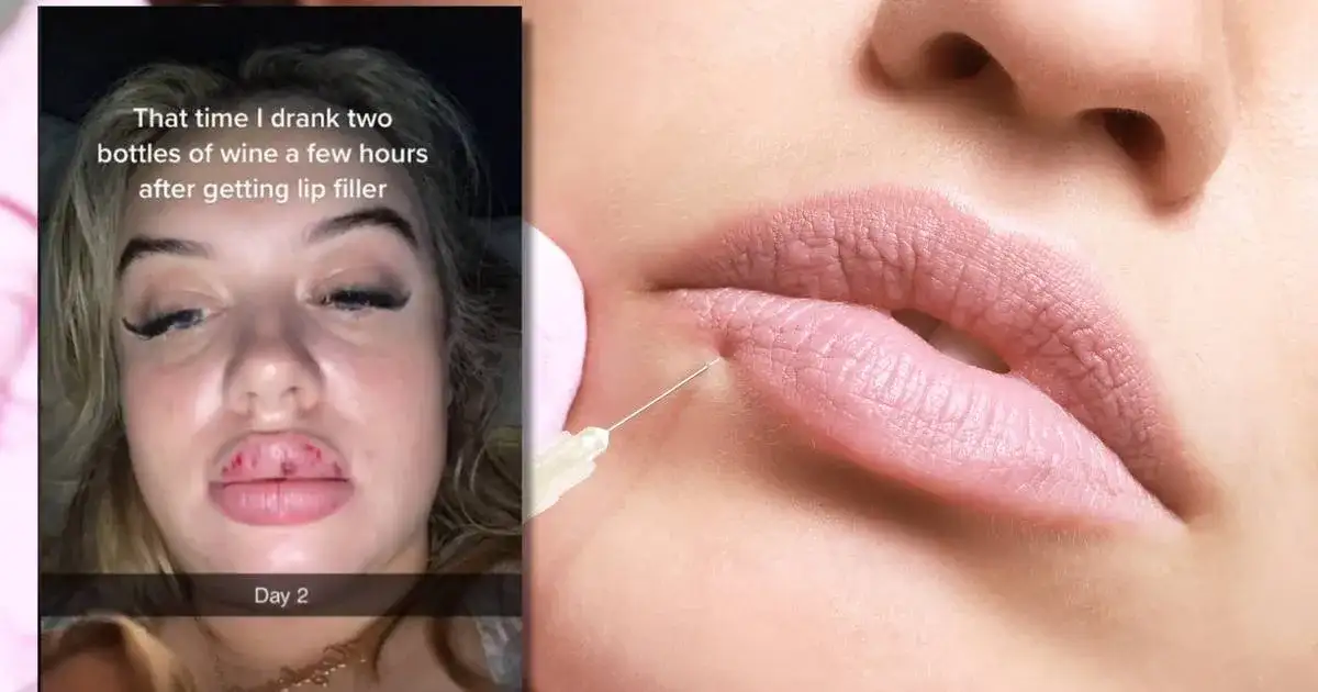 Czy można pić alkohol po powiększaniu ust? Dowiedz się o ryzyku.