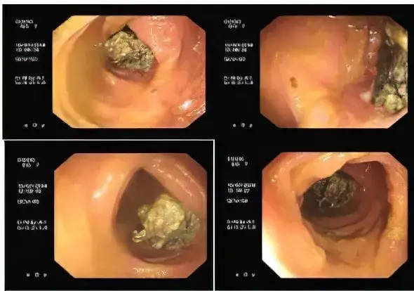 Niepokojące Objawy Po Operacji Przepukliny - Kiedy Szukać Pomocy