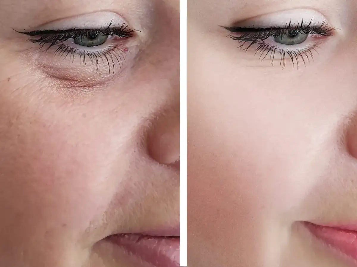 Botoks pod oczy: Kiedy efekty? Poznaj pełną oś czasu i trwałość