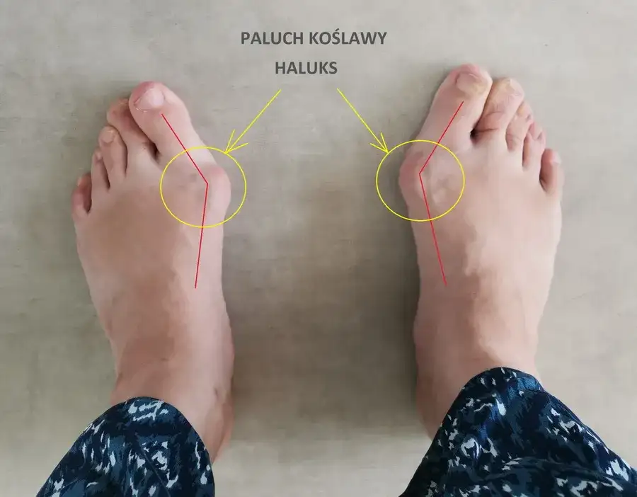Kiedy operować haluksy? Wskazania, leczenie i droga do zdrowia