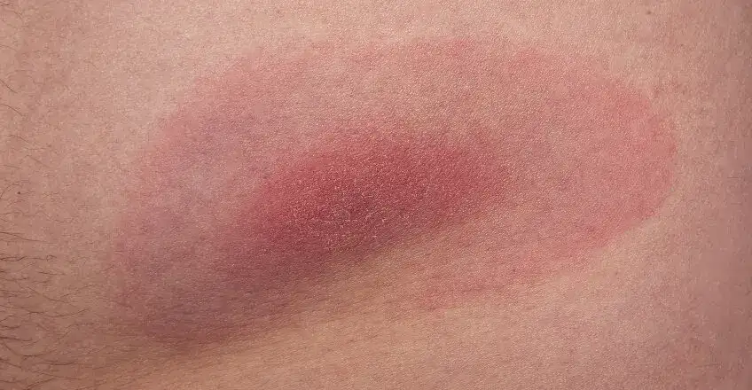 Rumień po kleszczu: Jak długo się utrzymuje? Odczyn czy borelioza?