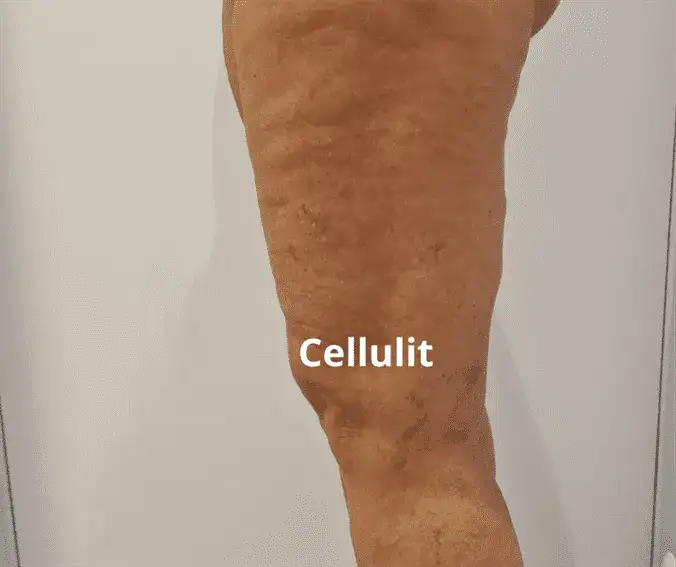 Co wam pomogło na cellulit? Skuteczne metody, które działają