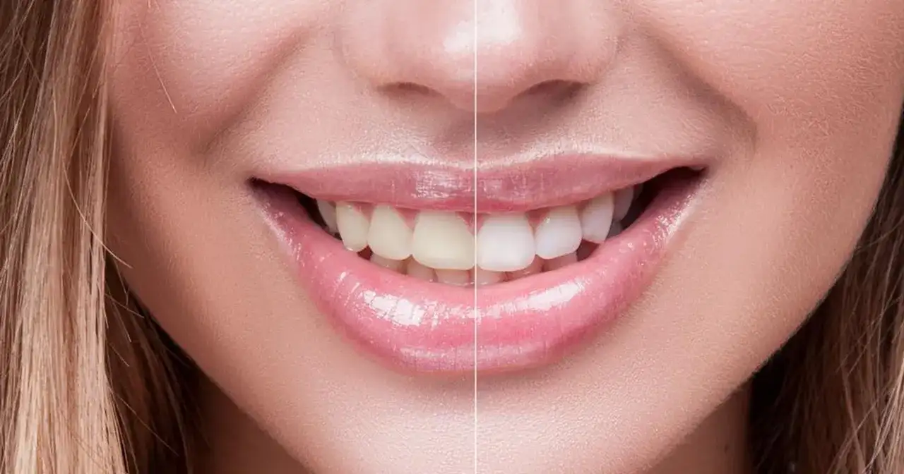 Skuteczne metody na wybielenie zębów w domu – uniknij problemów