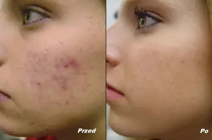 Skuteczne metody na gojenie ran po pryszczach i redukcję blizn